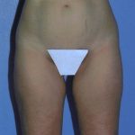 Liposuction Before & After Patient #4833