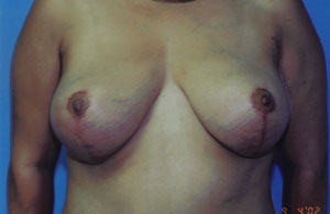 Breast Lift Before & After Patient #5007