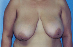 Breast Lift Before & After Patient #5007
