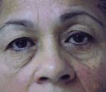 Facelift / Blepharoplasty Before & After Patient #4740