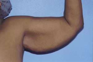 Brachioplasty Before & After Patient #4828