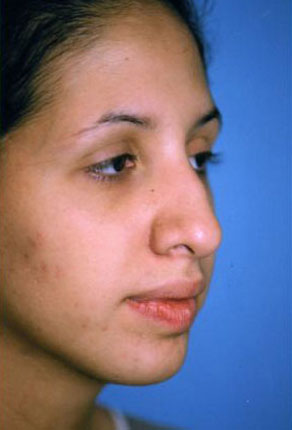 Rhinoplasty Before & After Patient #4789