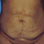 Tummy Tuck Before & After Patient #4855
