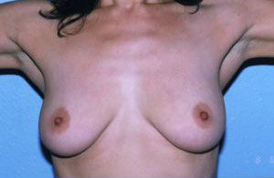 Breast Augmentation Before & After Patient #4916