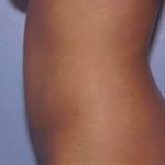 Liposuction Before & After Patient #4836