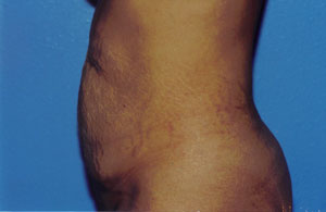 Tummy Tuck Before & After Patient #4855