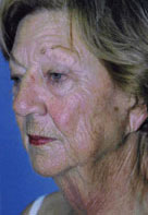 Facelift / Blepharoplasty Before & After Patient #4750