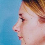 Rhinoplasty Before & After Patient #4796