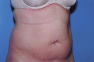Liposuction Before & After Patient #4843