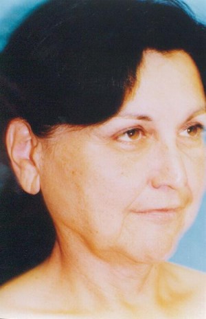 Facelift / Blepharoplasty Before & After Patient #4759