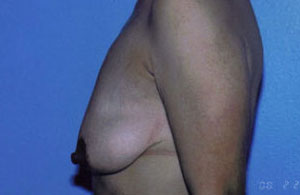 Breast Lift Before & After Patient #5026