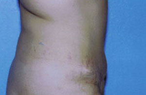 Tummy Tuck Before & After Patient #4869