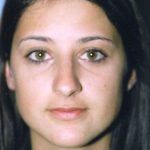 Rhinoplasty Before & After Patient #4812