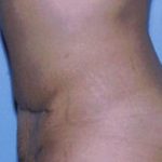 Tummy Tuck Before & After Patient #4874