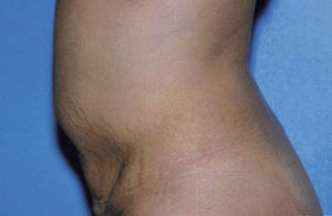 Tummy Tuck Before & After Patient #4874