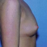 Breast Augmentation Before & After Patient #4941