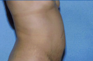 Tummy Tuck Before & After Patient #4874