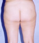 Tummy Tuck Before & After Patient #4881