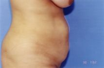 Tummy Tuck Before & After Patient #4889
