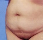 Tummy Tuck Before & After Patient #4889