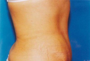 Tummy Tuck Before & After Patient #4899