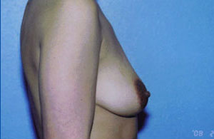 Breast Augmentation Before & After Patient #5000